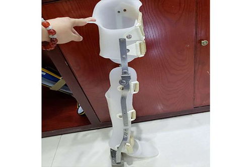 假肢與矯形器的使用周期與更換指南 科學維護，保障生活品質